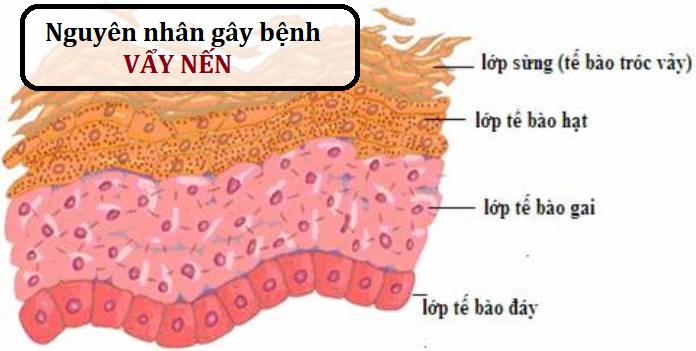 benh vay nen 1 lispharma d14520a9c59c447298bd00cb852e5e9d